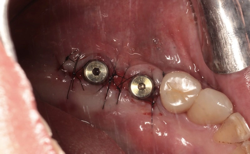 穩固重建,從「骨」開始! 數位化補骨結合人工植牙案例分享 穩固重建,從「骨」開始! 數位化補骨結合人工植牙案例分享