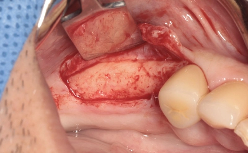 穩固重建,從「骨」開始! 數位化補骨結合人工植牙案例分享 穩固重建,從「骨」開始! 數位化補骨結合人工植牙案例分享