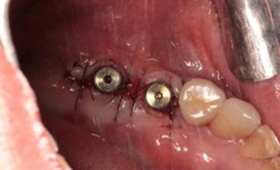 穩固重建,從「骨」開始! 數位化補骨結合人工植牙案例分享 穩固重建,從「骨」開始! 數位化補骨結合人工植牙案例分享