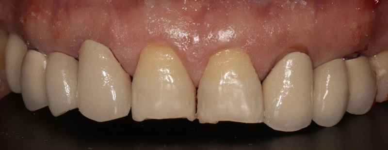 笑容的逆齡術！ 陶瓷貼片與全鋯冠牙橋，重塑自信黃金比例