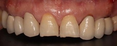 笑容的逆齡術! 陶瓷貼片與全鋯冠牙橋,重塑自信黃金比例 笑容的逆齡術! 陶瓷貼片與全鋯冠牙橋,重塑自信黃金比例