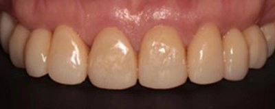 笑容的逆齡術! 陶瓷貼片與全鋯冠牙橋,重塑自信黃金比例 笑容的逆齡術! 陶瓷貼片與全鋯冠牙橋,重塑自信黃金比例