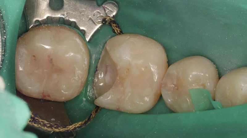 超越傳統填補！陶瓷嵌體（3D齒雕），還原牙齒完整強度與外形