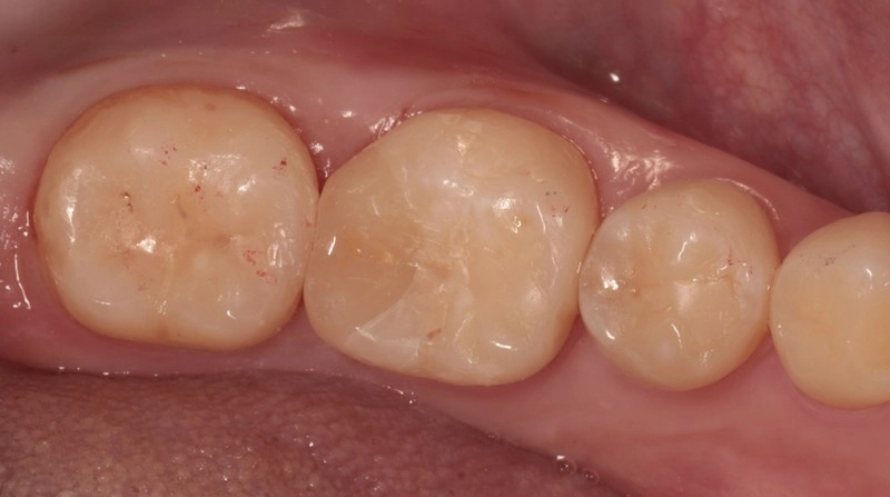 超越傳統填補！陶瓷嵌體（3D齒雕），還原牙齒完整強度與外形