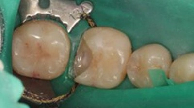 超越傳統填補!陶瓷嵌體(3D齒雕),還原牙齒完整強度與外形 超越傳統填補!陶瓷嵌體(3D齒雕),還原牙齒完整強度與外形