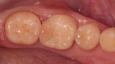 超越傳統填補!陶瓷嵌體(3D齒雕),還原牙齒完整強度與外形 超越傳統填補!陶瓷嵌體(3D齒雕),還原牙齒完整強度與外形