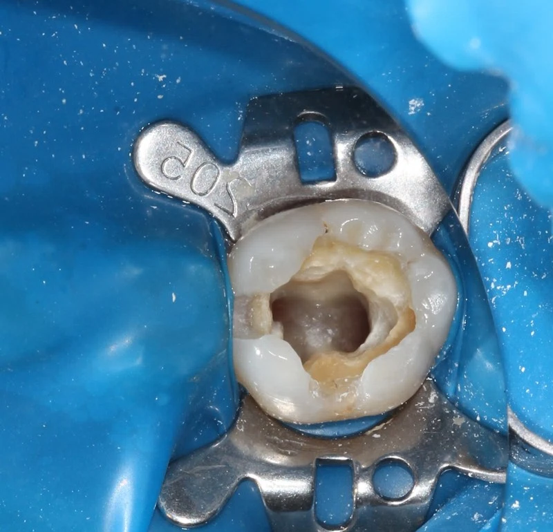 精準根管治療後的新標準!微創陶瓷嵌體,延長自然牙的壽命 精準根管治療後的新標準!微創陶瓷嵌體,延長自然牙的壽命