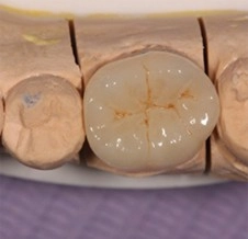 精準根管治療後的新標準!微創陶瓷嵌體,延長自然牙的壽命 精準根管治療後的新標準!微創陶瓷嵌體,延長自然牙的壽命