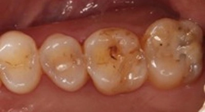 顯微拯救危「裂」牙! 顯微根管治療+全鋯冠,搶救大臼齒功能 顯微拯救危「裂」牙! 顯微根管治療+全鋯冠,搶救大臼齒功能