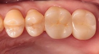 顯微拯救危「裂」牙! 顯微根管治療+全鋯冠,搶救大臼齒功能 顯微拯救危「裂」牙! 顯微根管治療+全鋯冠,搶救大臼齒功能