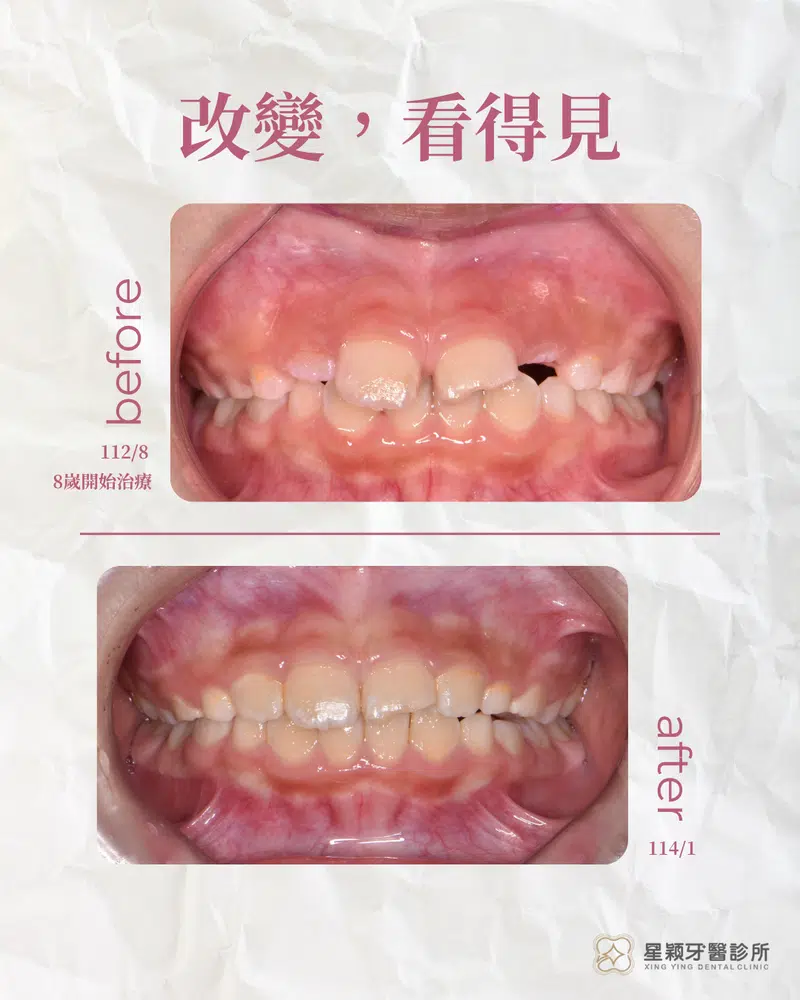 MRC早期兒童矯正