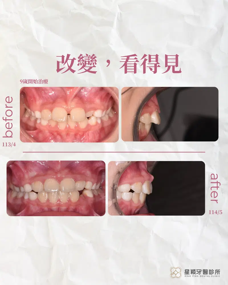 MRC早期兒童矯正