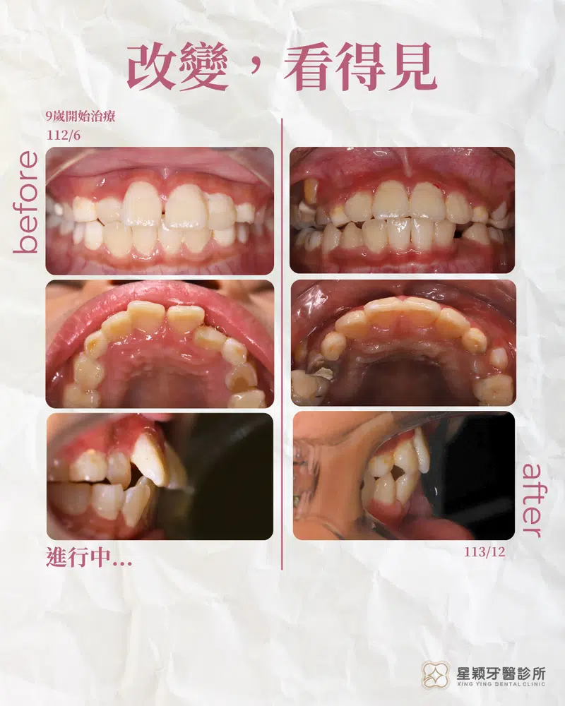 MRC早期兒童矯正