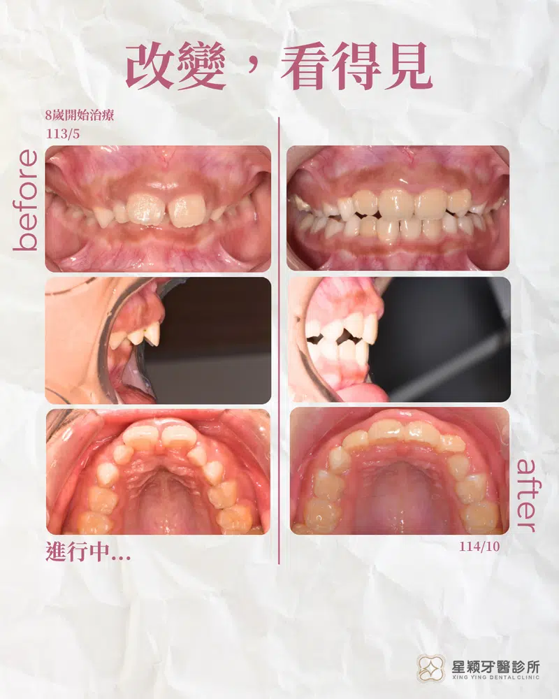 MRC早期兒童矯正