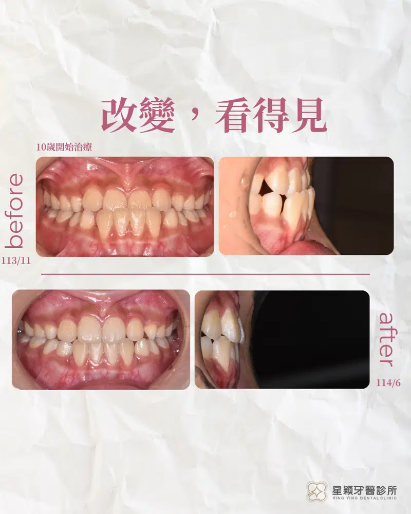 MRC早期兒童矯正