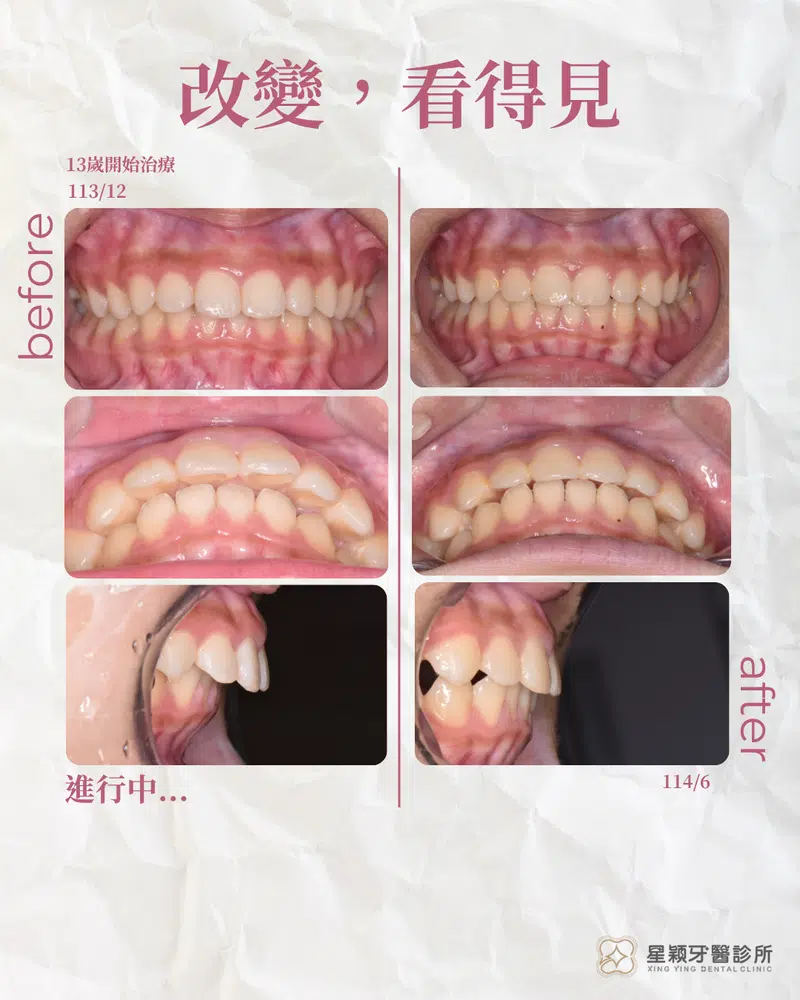 MRC早期兒童矯正