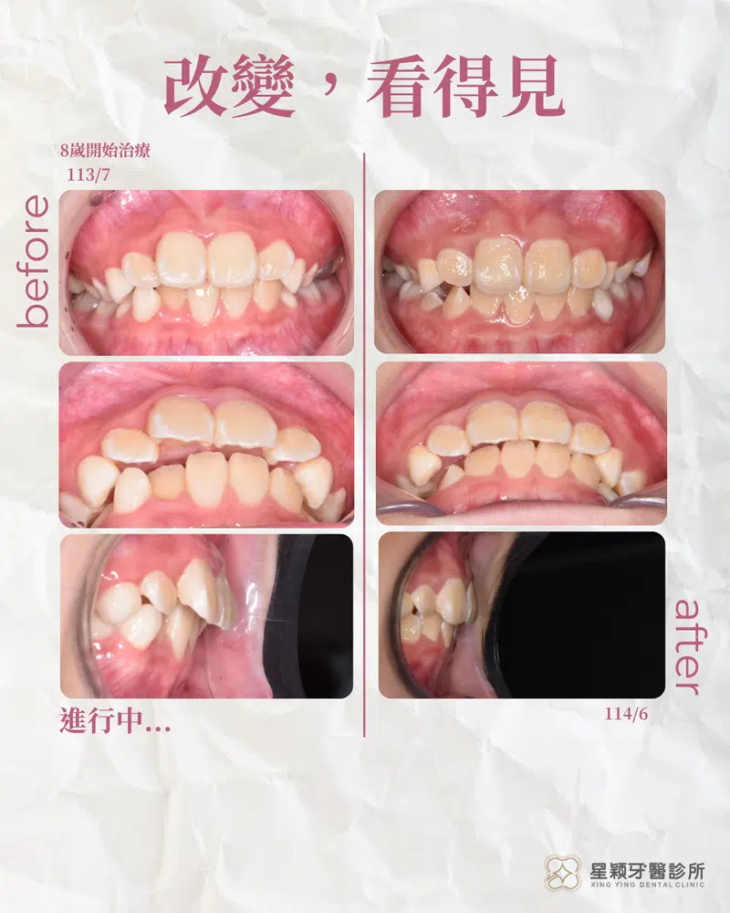 MRC早期兒童矯正