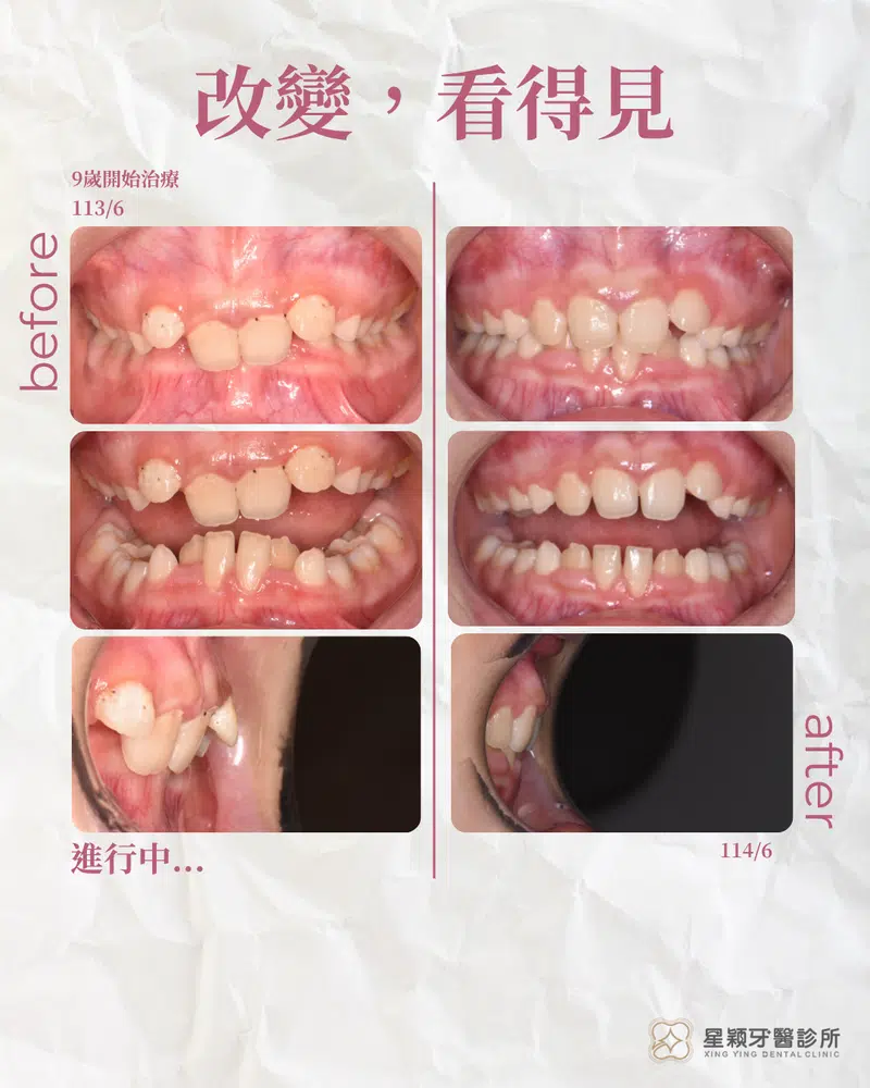 MRC早期兒童矯正