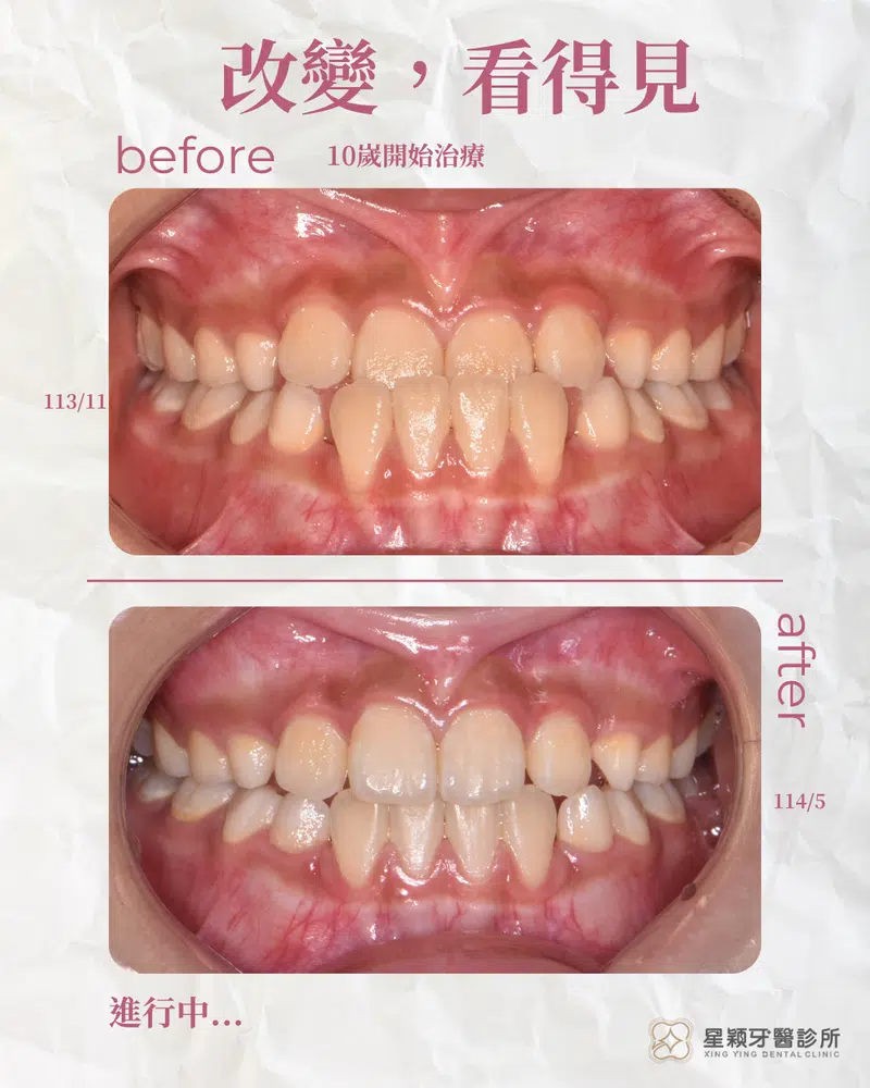 MRC早期兒童矯正