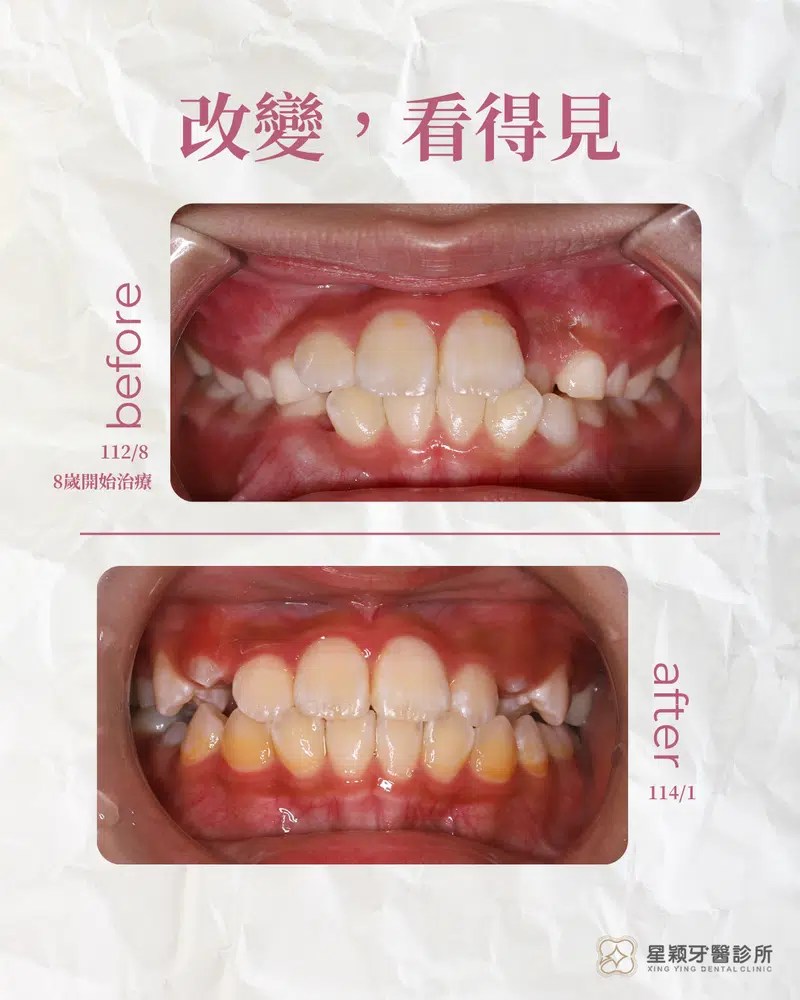 MRC早期兒童矯正