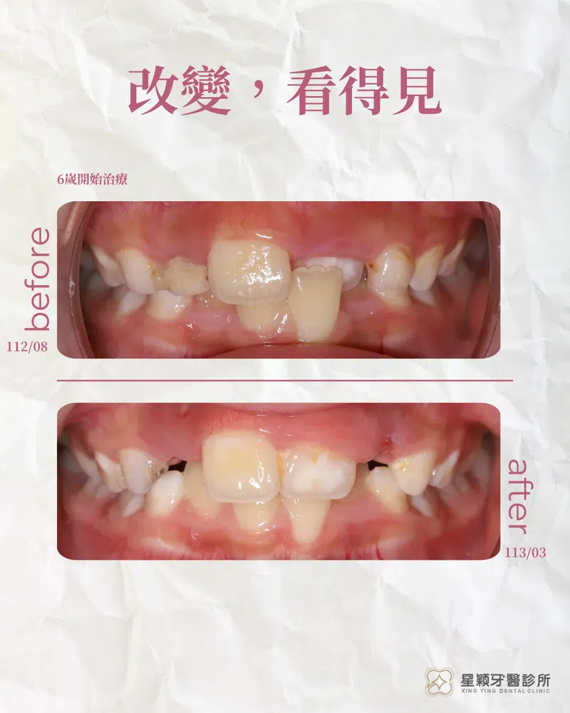 MRC早期兒童矯正