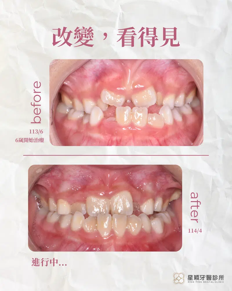 MRC早期兒童矯正