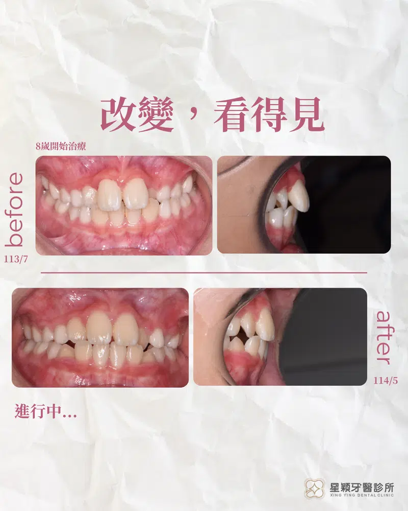 MRC早期兒童矯正