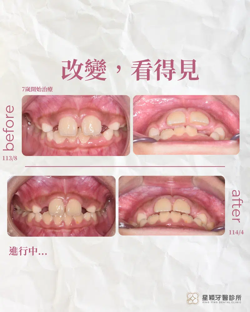 MRC早期兒童矯正