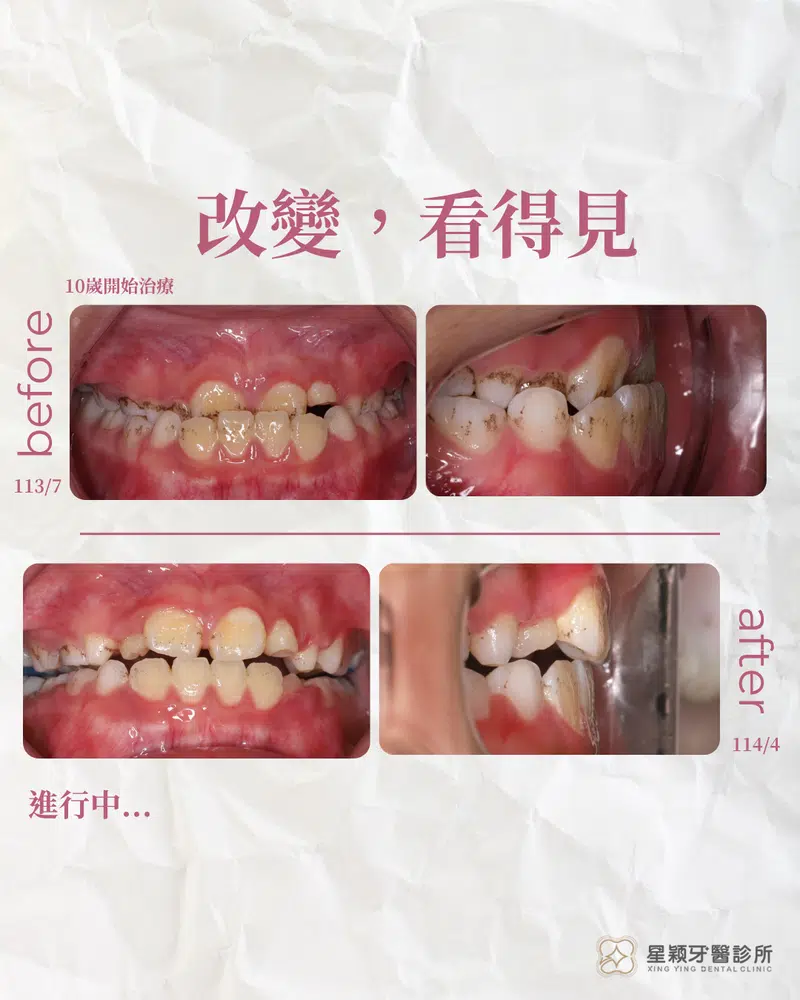 MRC早期兒童矯正