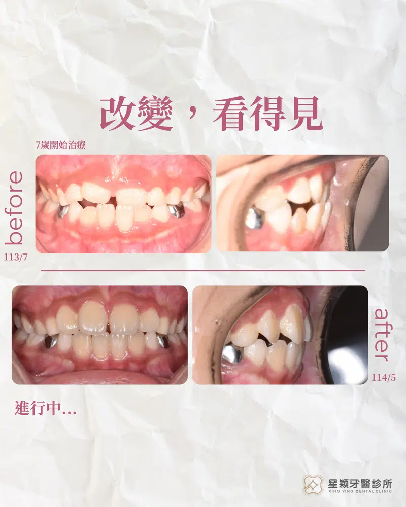 MRC早期兒童矯正